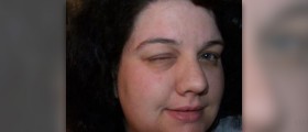 Reduce swelling in face