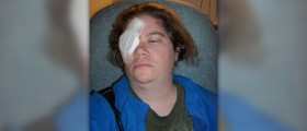 Refractive eye surgery