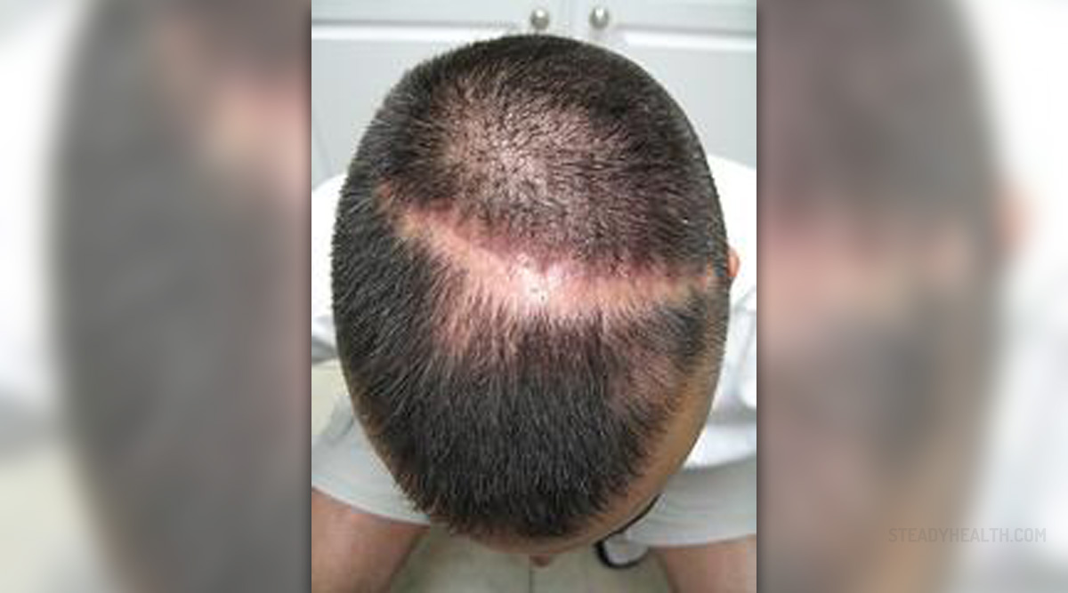 Regrow Thinning Hair Naturally General Center Steadyhealth Com