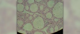 Removal of thyroid gland
