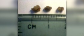 Renal calculi or kidney stone symptoms