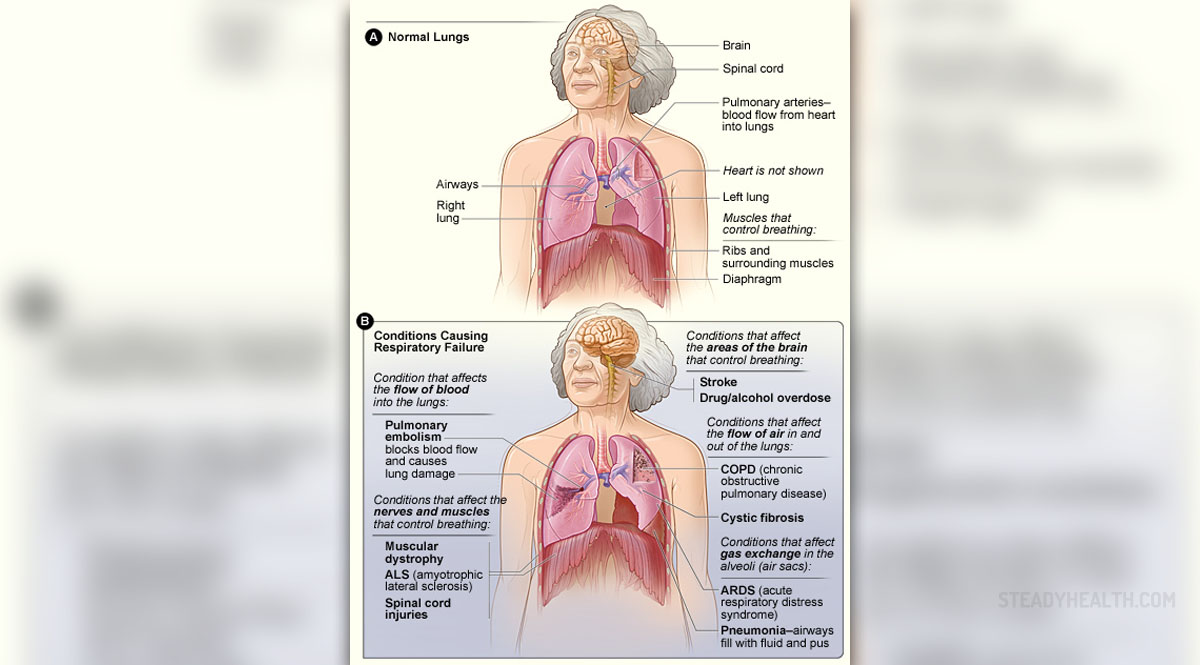 respiratory-failure-review-general-center-steadyhealth