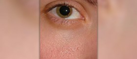 Retinopathy and diabetic macular edema