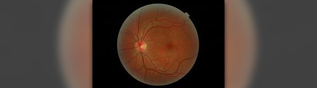 torn retina symptoms treatment