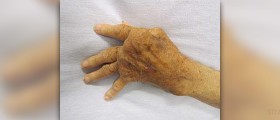 Rheumatic fever facts