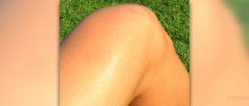 Rheumatoid arthritis in knee