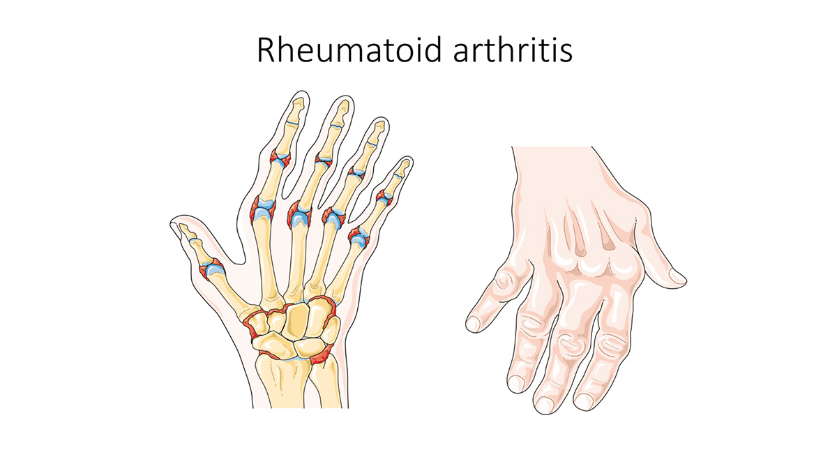 Diet plan for rheumatoid arthritis | General center | SteadyHealth.com