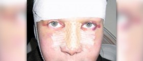 Rhinoplasty : know your nose