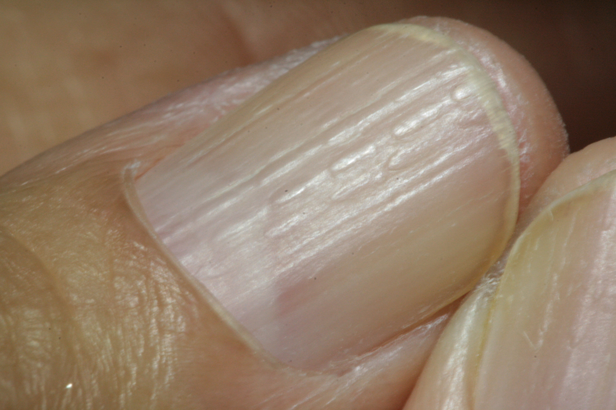fingernails odd spreading of white area