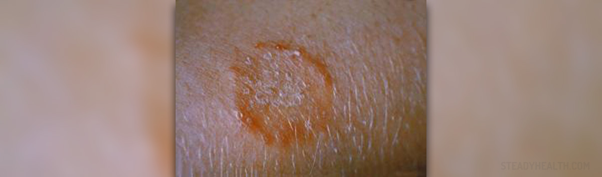 Ringworm rash info | General center | SteadyHealth.com