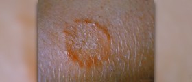 Ringworm rash info