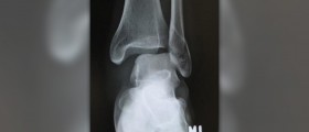 Rolled ankle facts