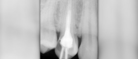 Root canal symptoms