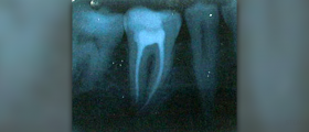 Root canal treatment