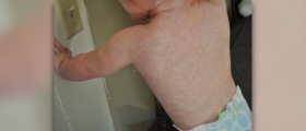 Roseola virus facts