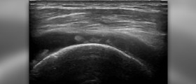 Rotator cuff injury - torn rotator cuff