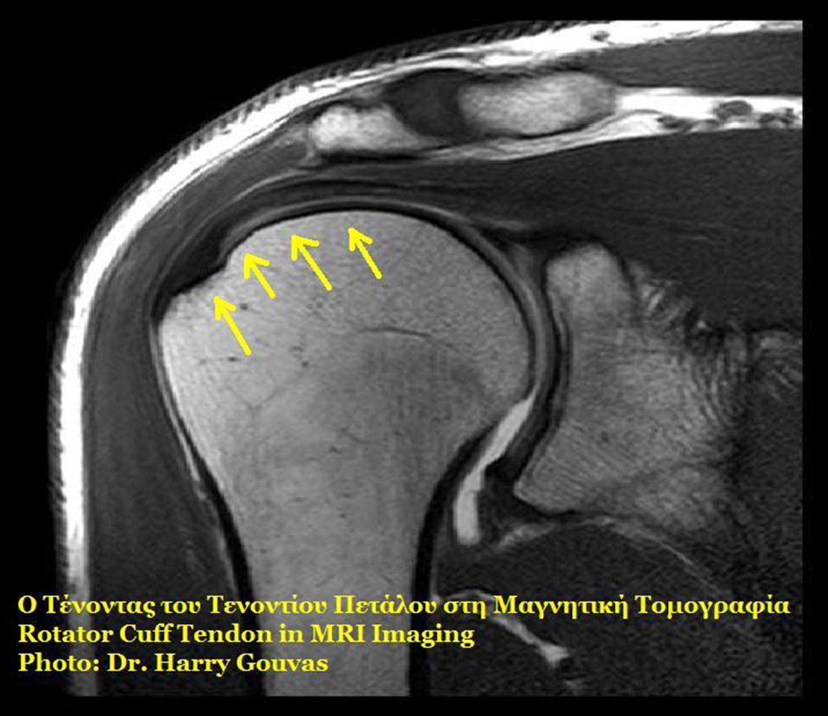 Rotator cuff symptoms | General center | SteadyHealth.com