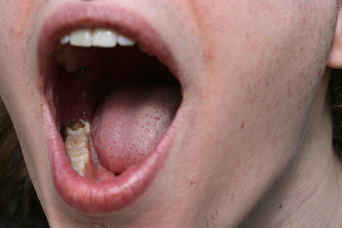 rotting-teeth-problems-general-center-steadyhealth