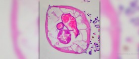Roundworm infection: pinworms