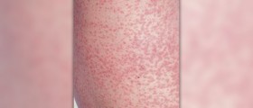 Rubella (German measles) - Little red disease