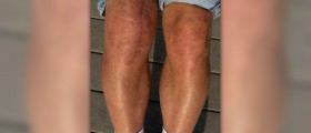 Runner's knee: Recovery time and pain management