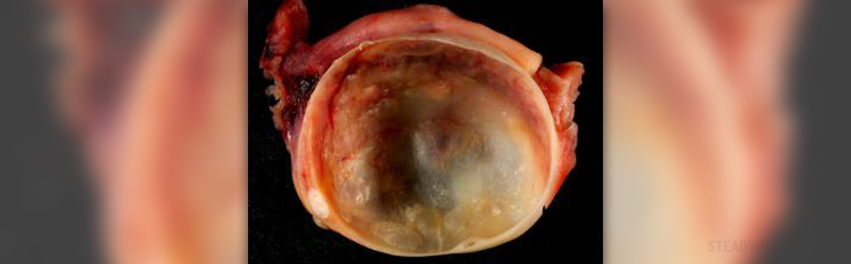 Can A Ruptured Ovarian Cyst Cause Blood In Stool