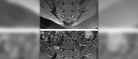 Sacroiliac joint exercises