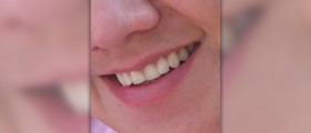 Save your smile with exclusive teeth whitening kits