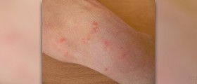 Scabies rash facts