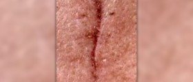 Scar removal remedies