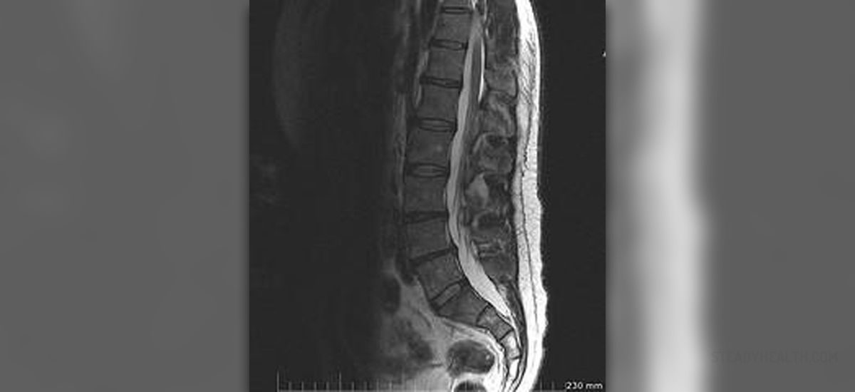 Sciatic nerve damage | General center | SteadyHealth.com