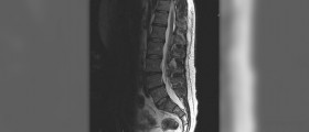 Sciatic nerve damage