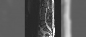 Sciatica exercises and self-care