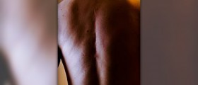 Scoliosis surgery review