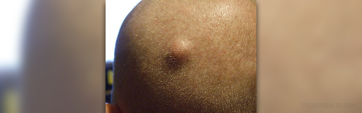 Sebaceous Cyst