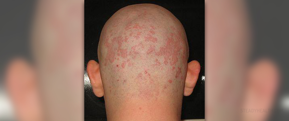 seborrheic-dermatitis-body-skin-hair-problems-articles-body