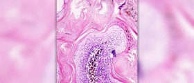 Seborrheic dermatitis in kids