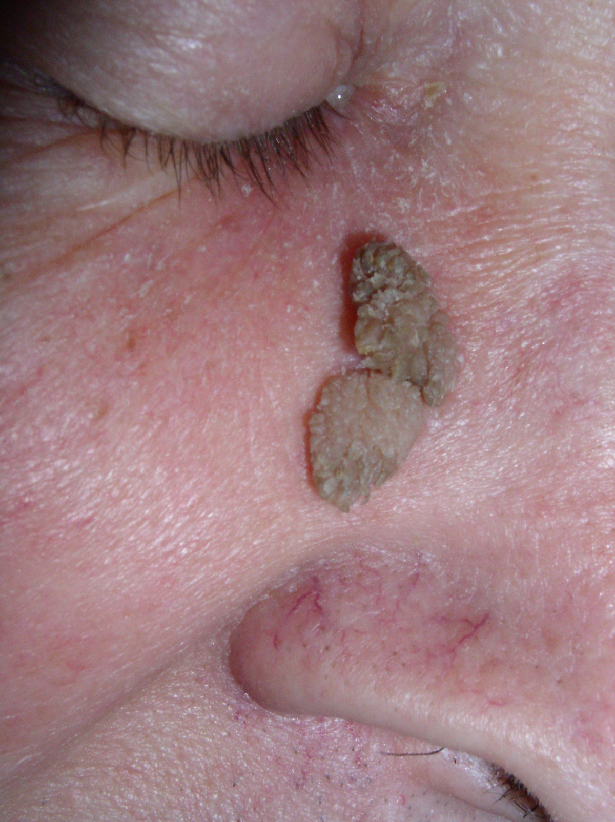 home remedies for seborrheic dermatitis