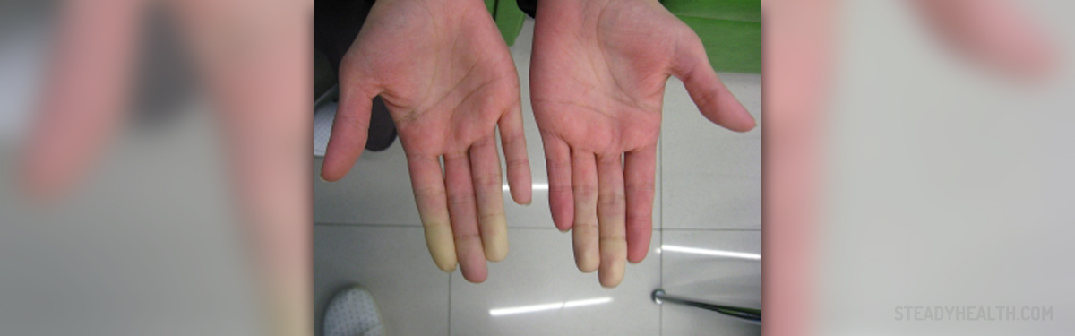 Raynaud's disease - A circulation problem | Cardiovascular Disorders