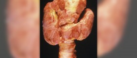 Selenium and your thyroid problems
