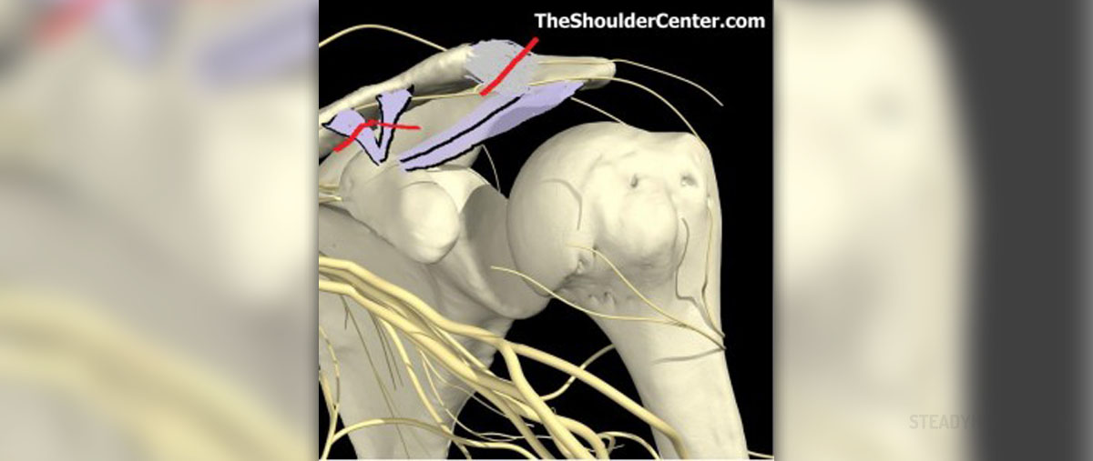 anterior-shoulder-dislocation-prereduction-ap-xray-annotated-jetem