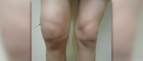 Severe knee pain
