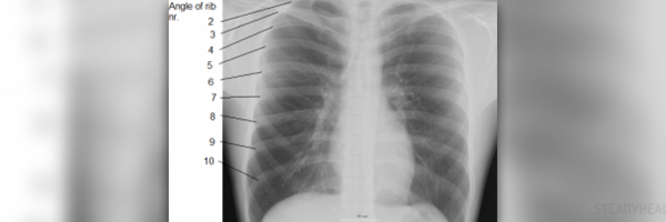 Sharp pain in ribs