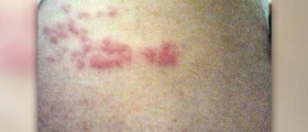 Shingles during pregnancy