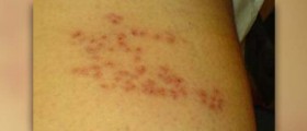 Shingles rash facts