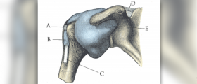 Shoulder bone spur