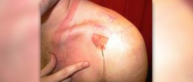 Shoulder pain when lifting arm