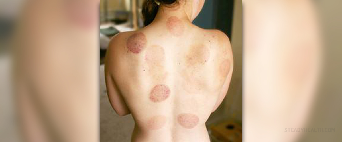 Side Effects Of Cupping Therapy Alternative Medicine And Healing