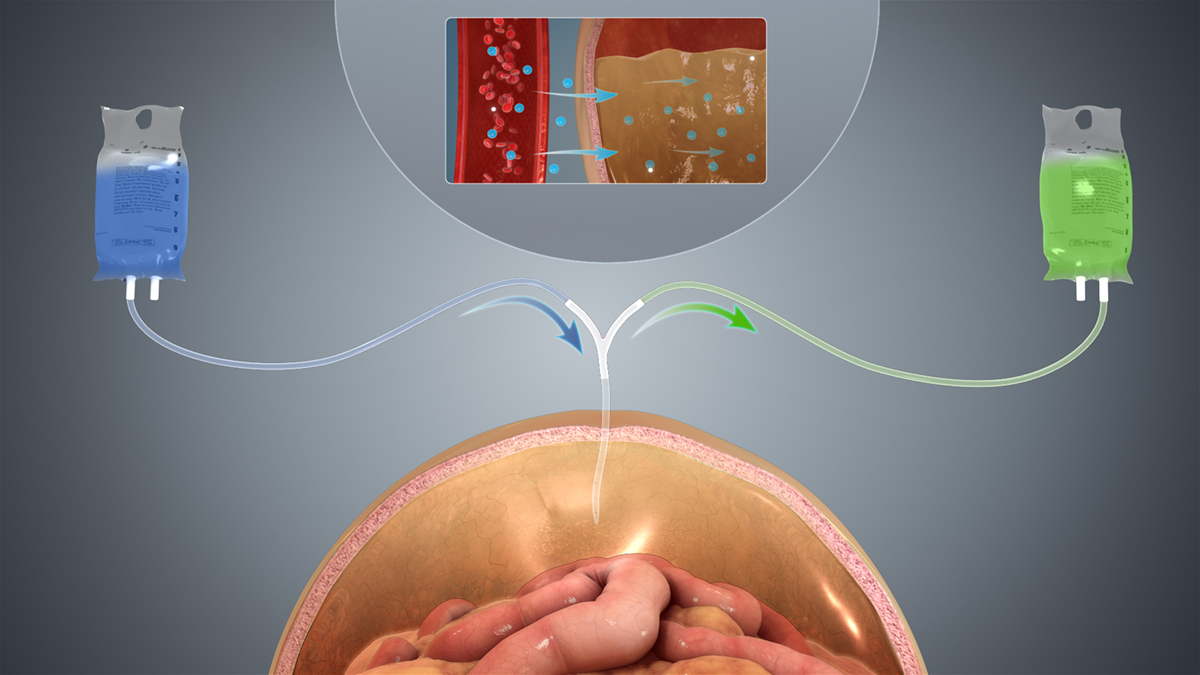 side effects of iopidine eye drops