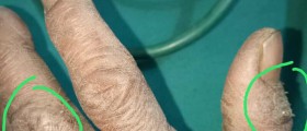 Side effects of steroids in children